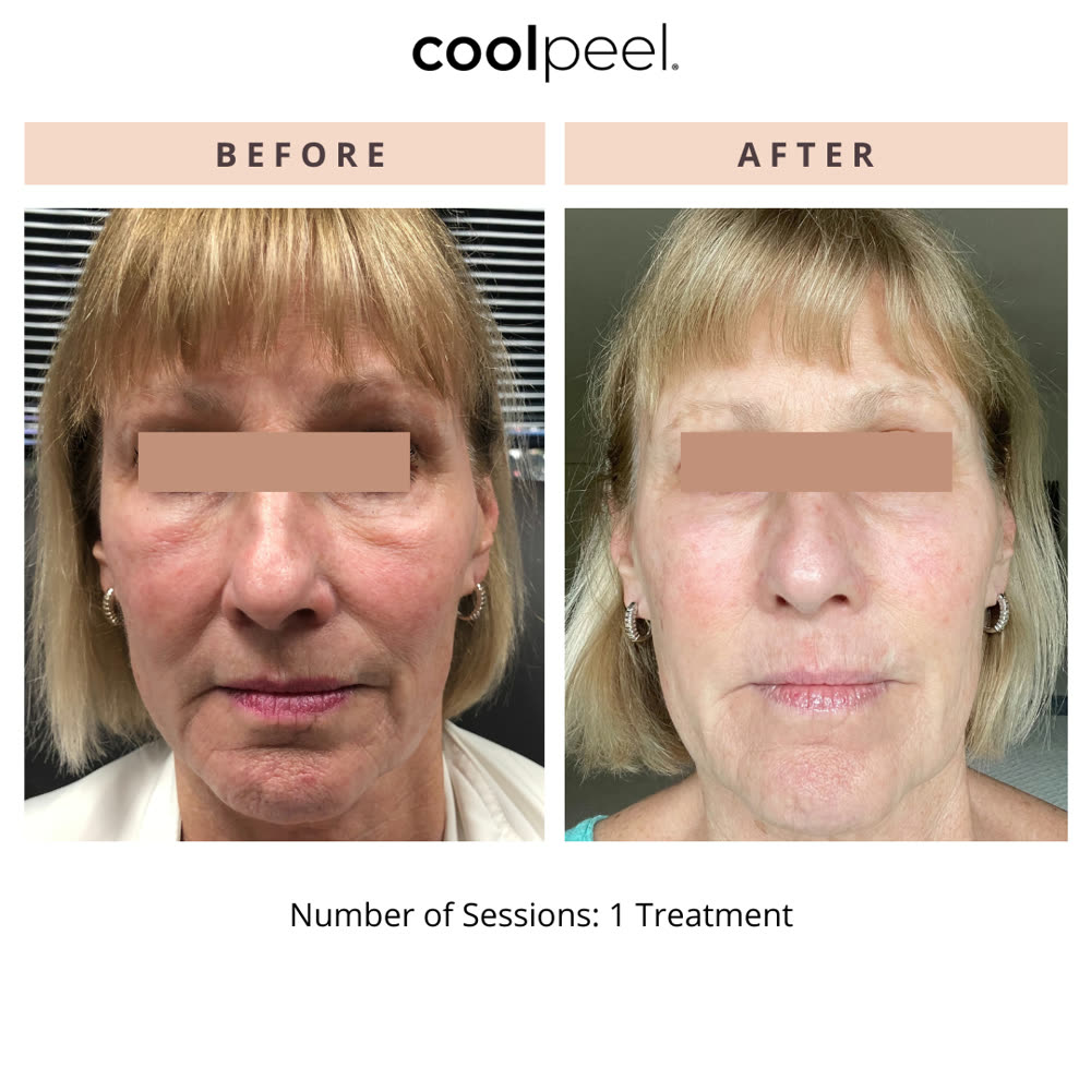 CoolPeel before and after