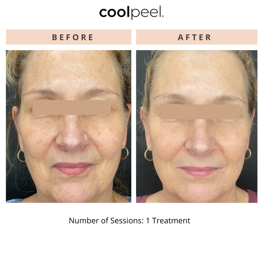 CoolPeel before and after