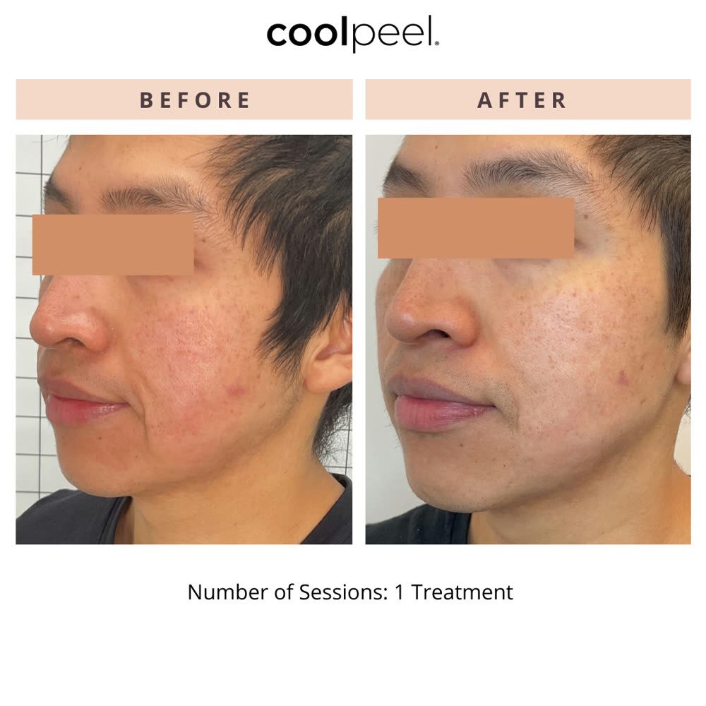 CoolPeel before and after