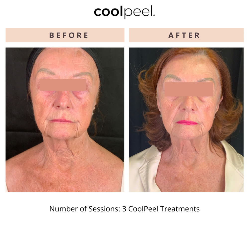 CoolPeel before and after