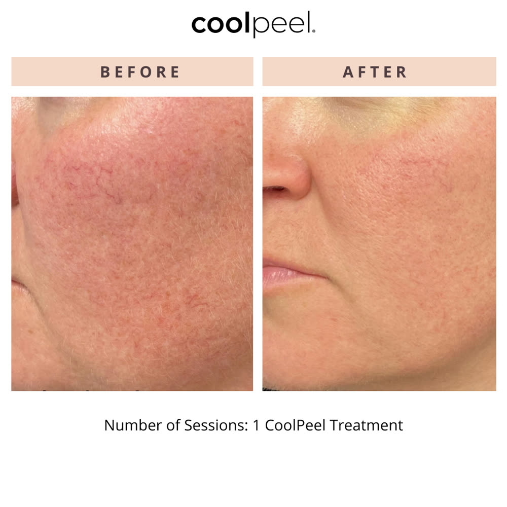 CoolPeel before and after