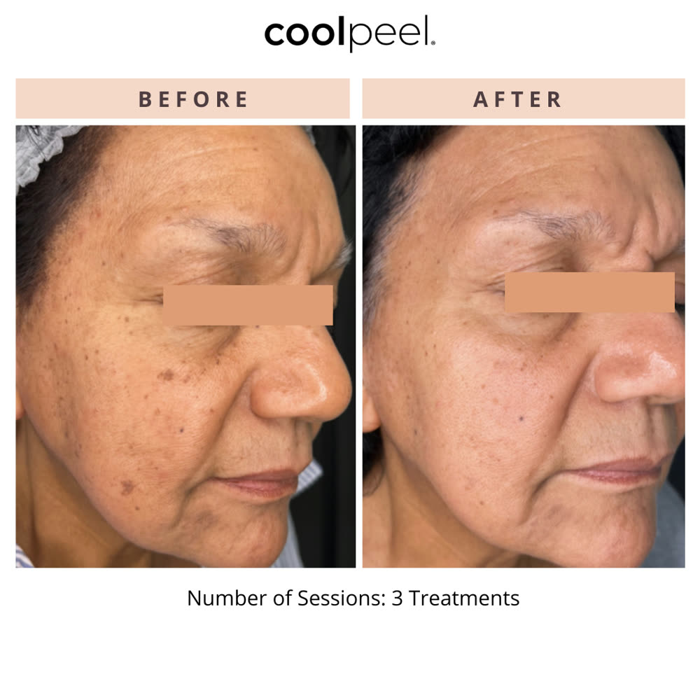 CoolPeel before and after
