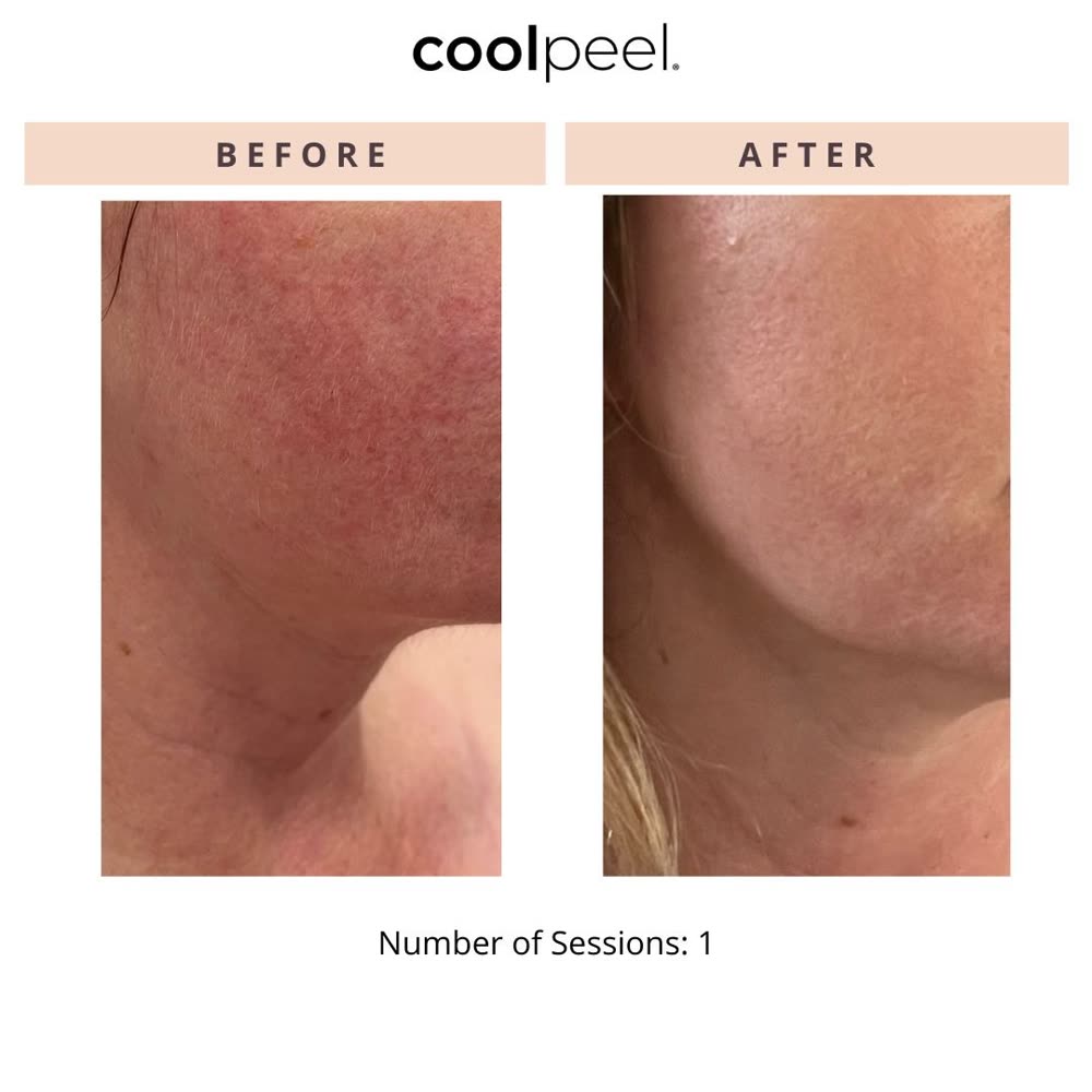 CoolPeel before and after