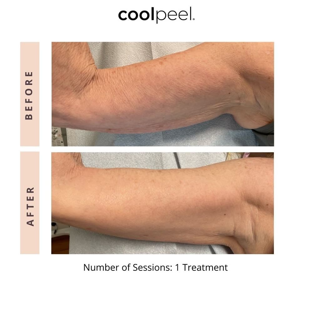 CoolPeel before and after