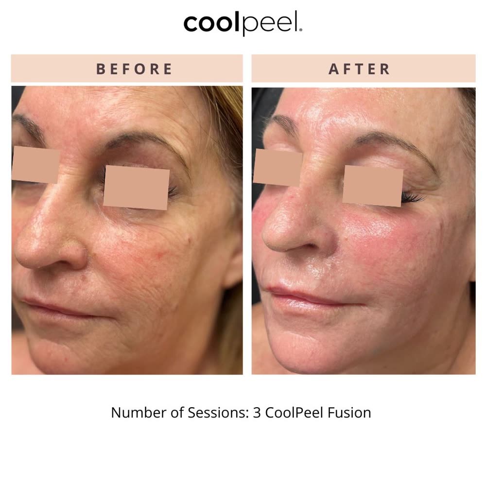 CoolPeel before and after