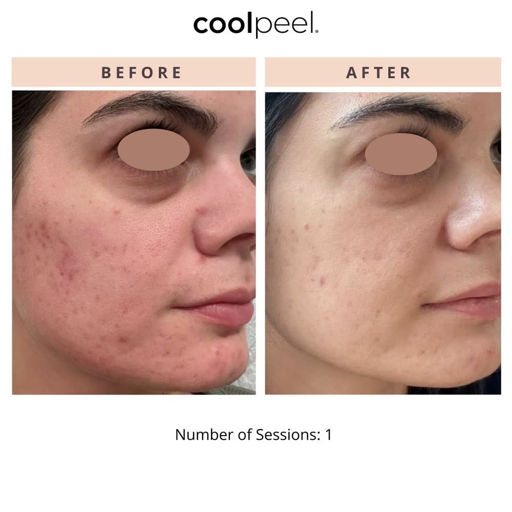 CoolPeel before and after