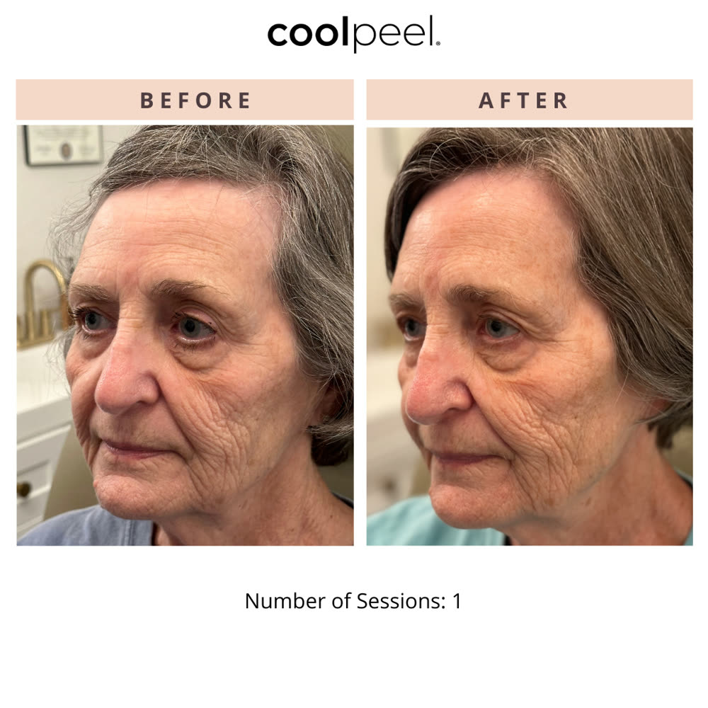 CoolPeel before and after