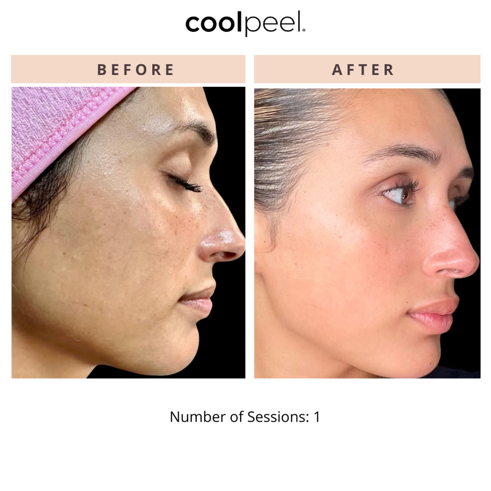 CoolPeel before and after