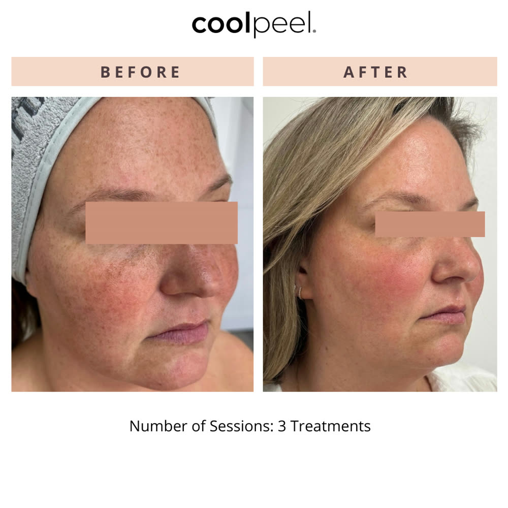 CoolPeel before and after