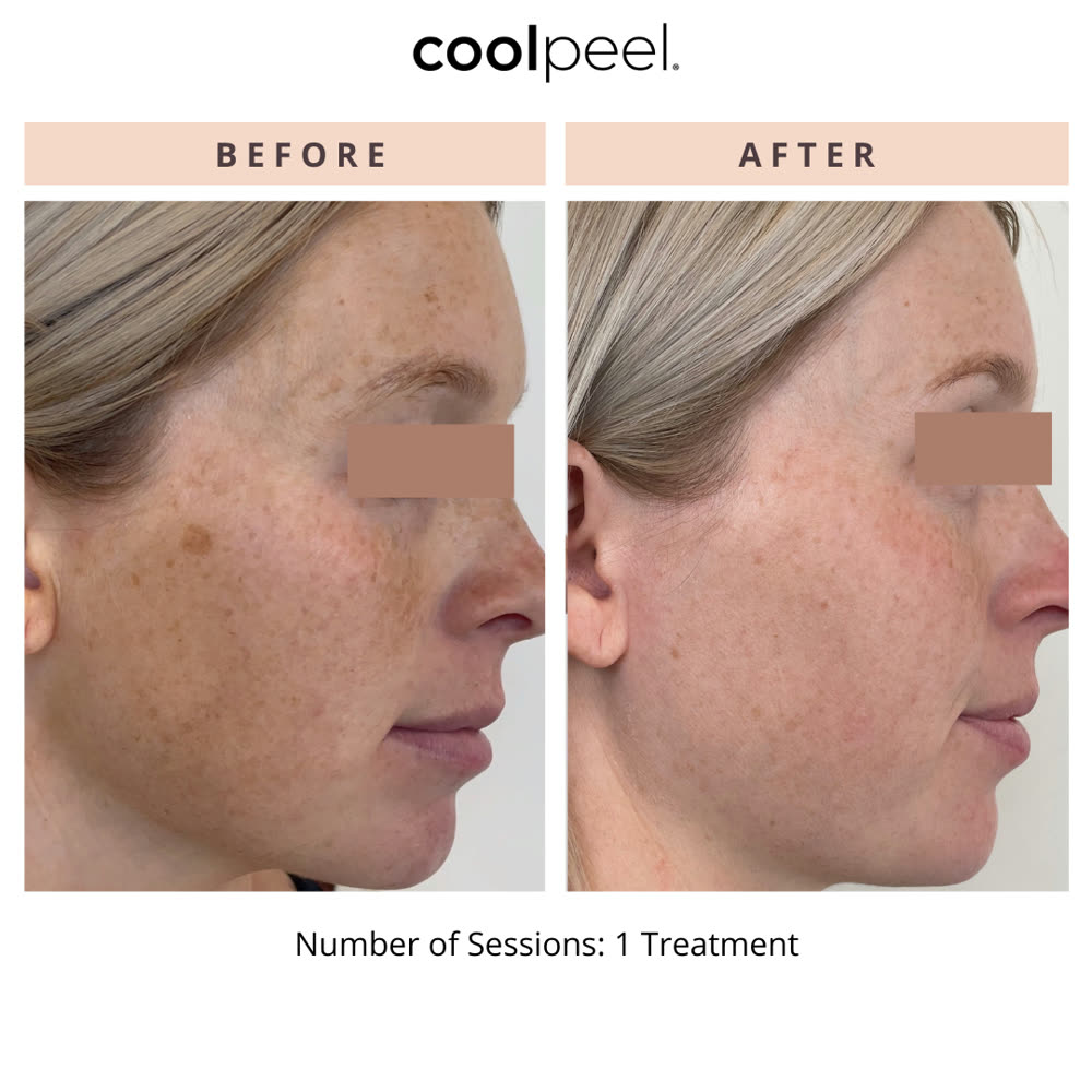 CoolPeel before and after