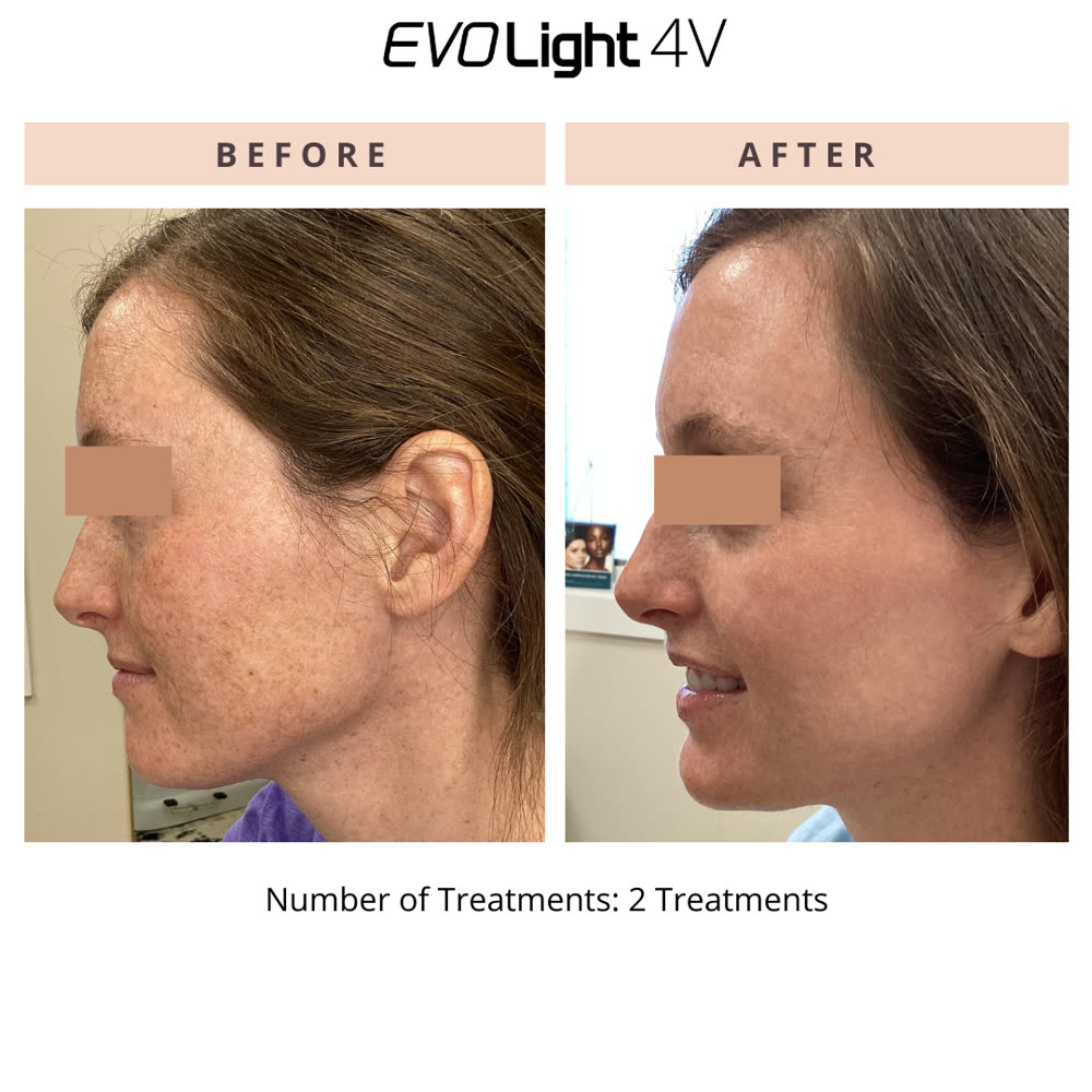 EVO Light before and after