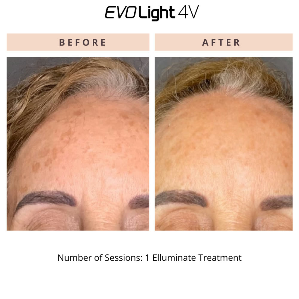 EVO Light before and after