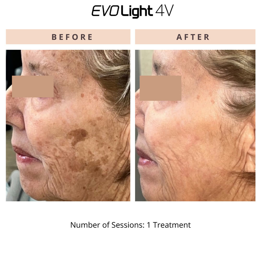 EVO Light before and after