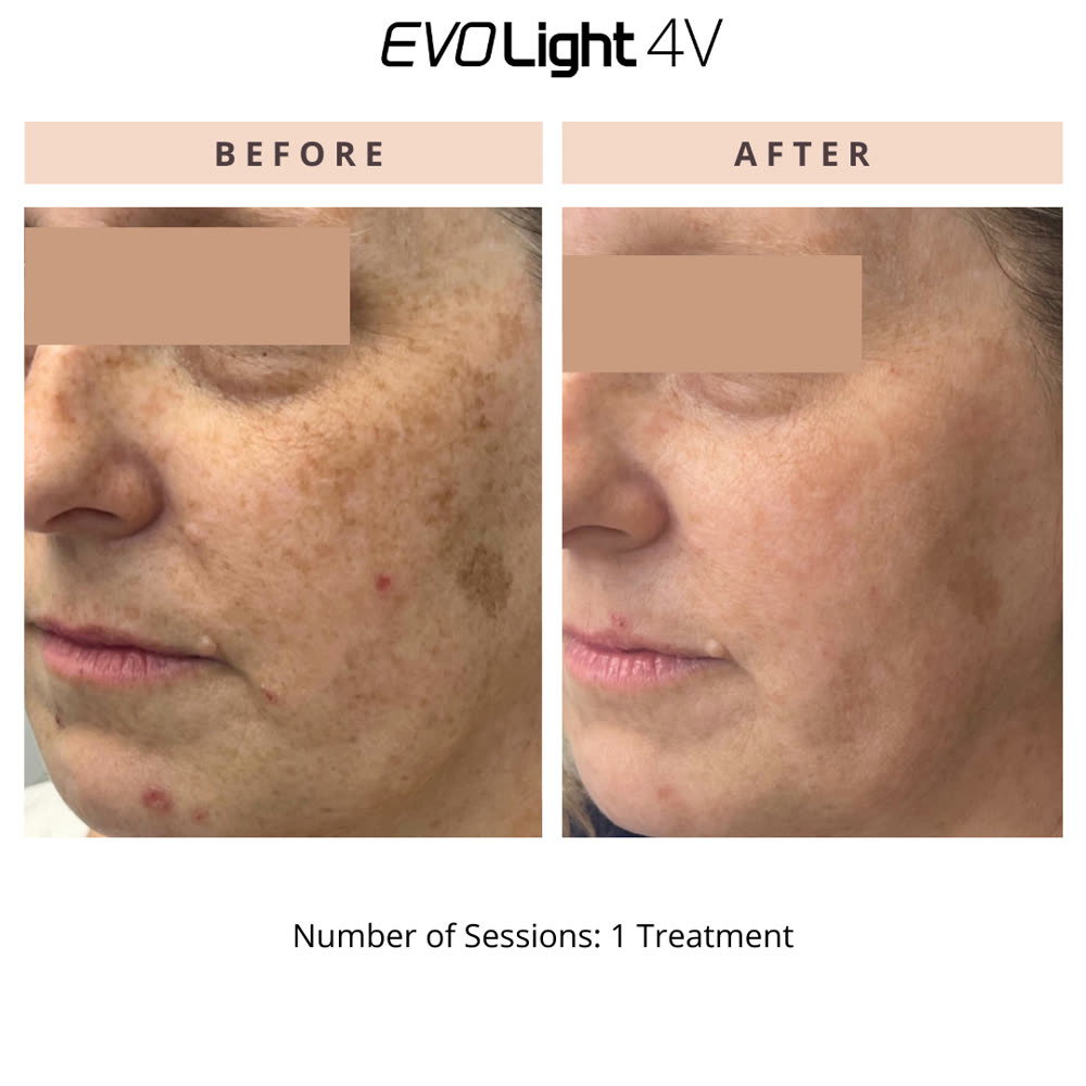 EVO Light before and after