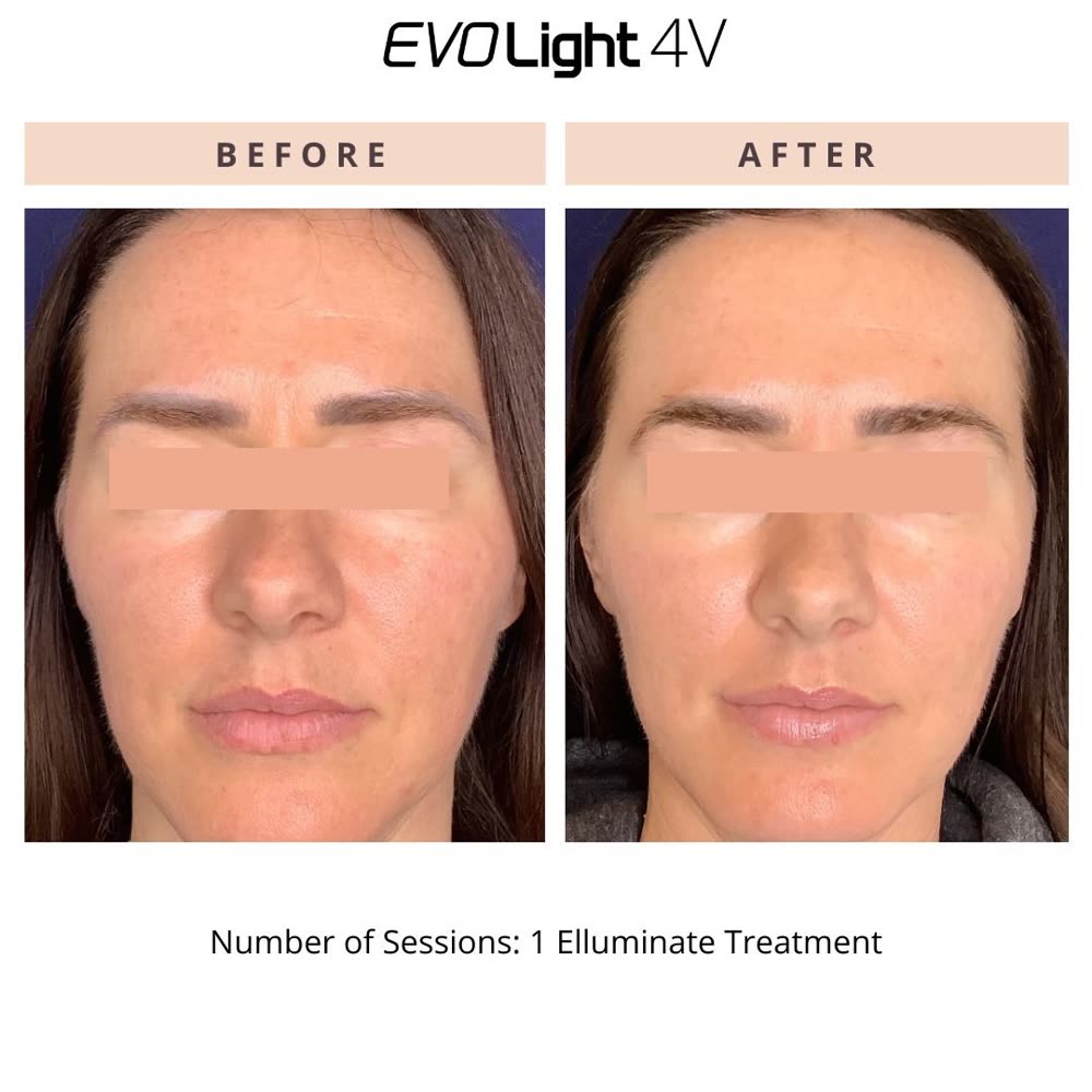 EVO Light before and after