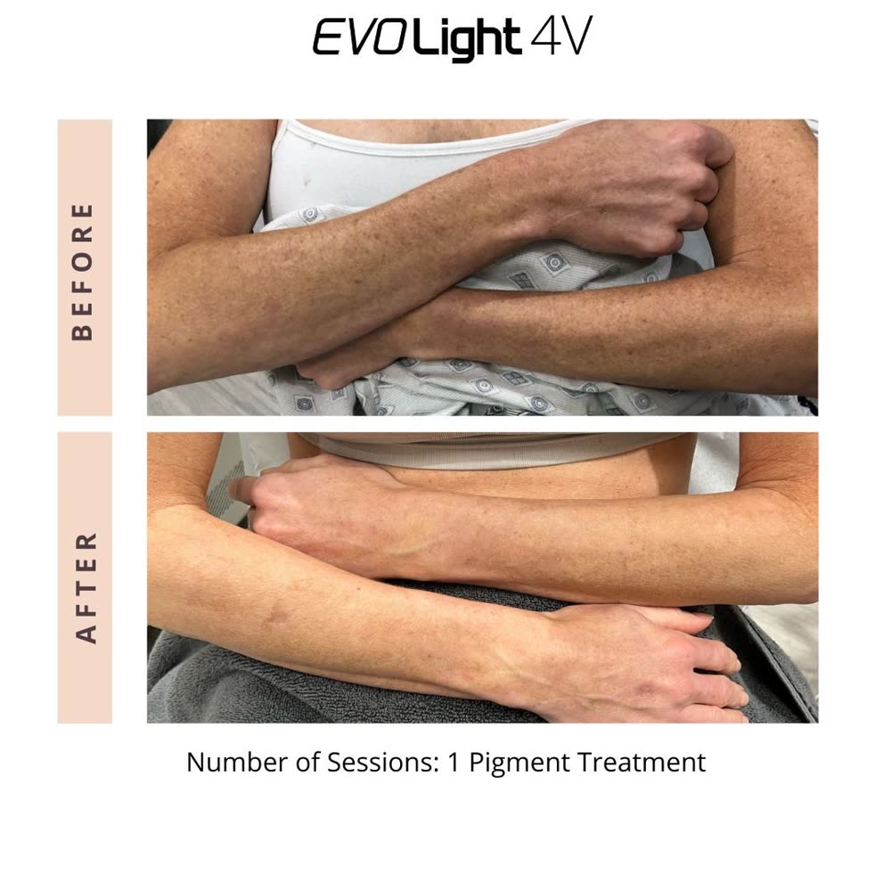 EVO Light before and after