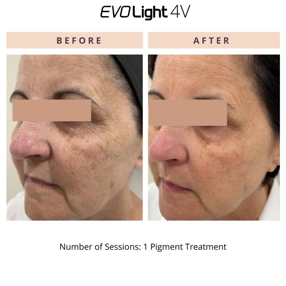 EVO Light before and after