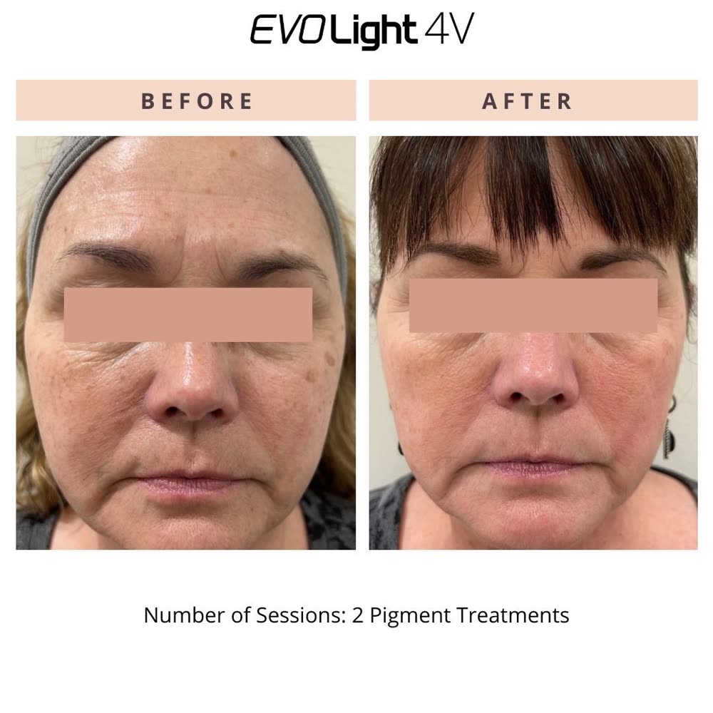EVO Light before and after