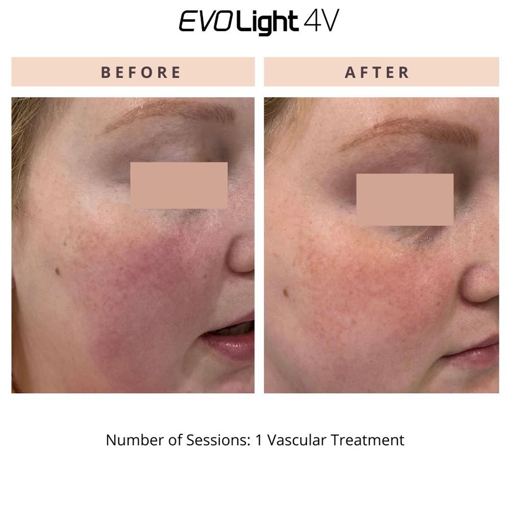 EVO Light before and after