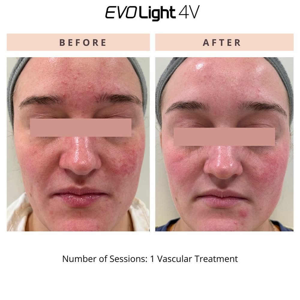 EVO Light before and after