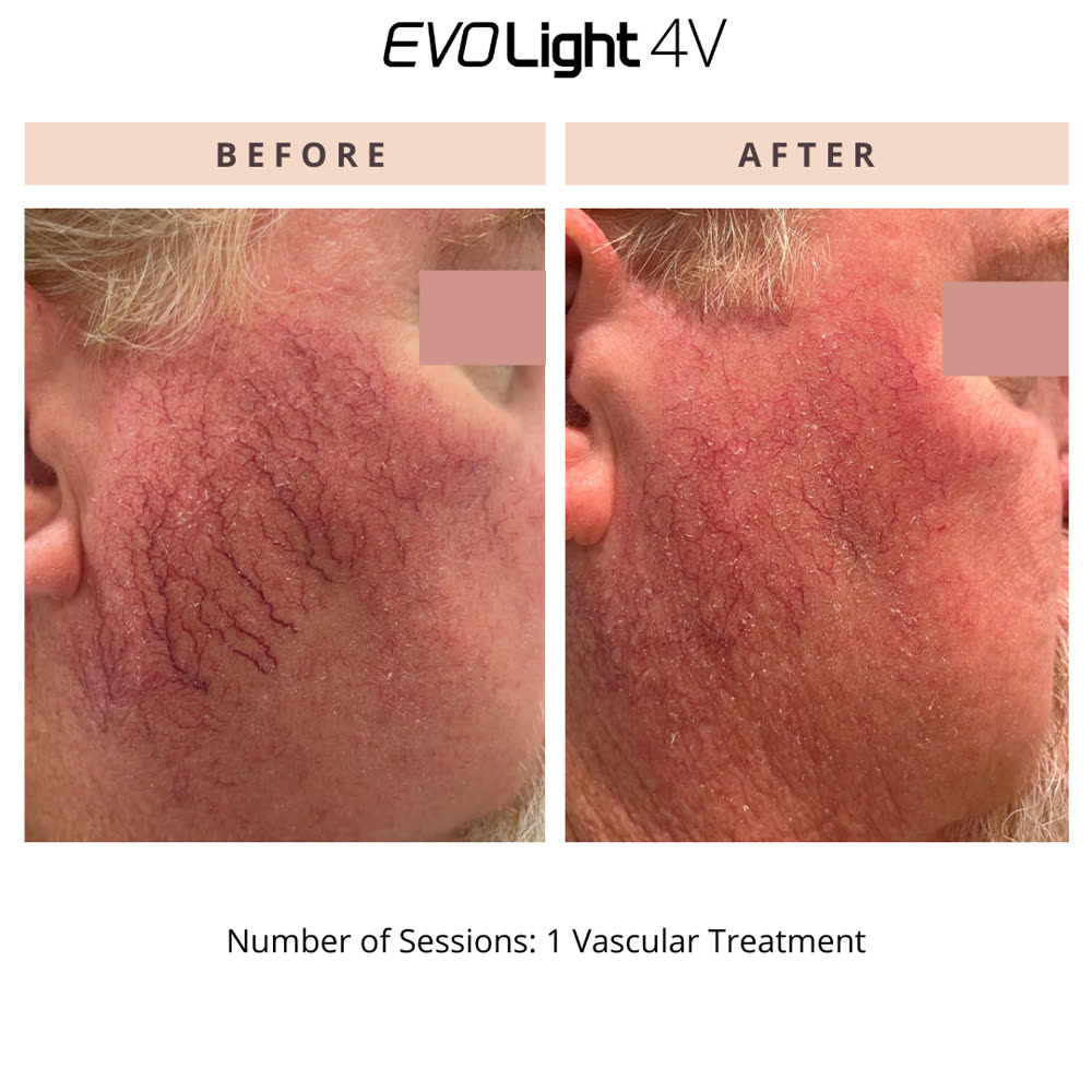 EVO Light before and after