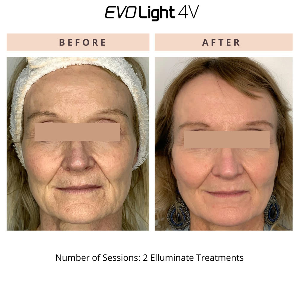 EVO Light before and after