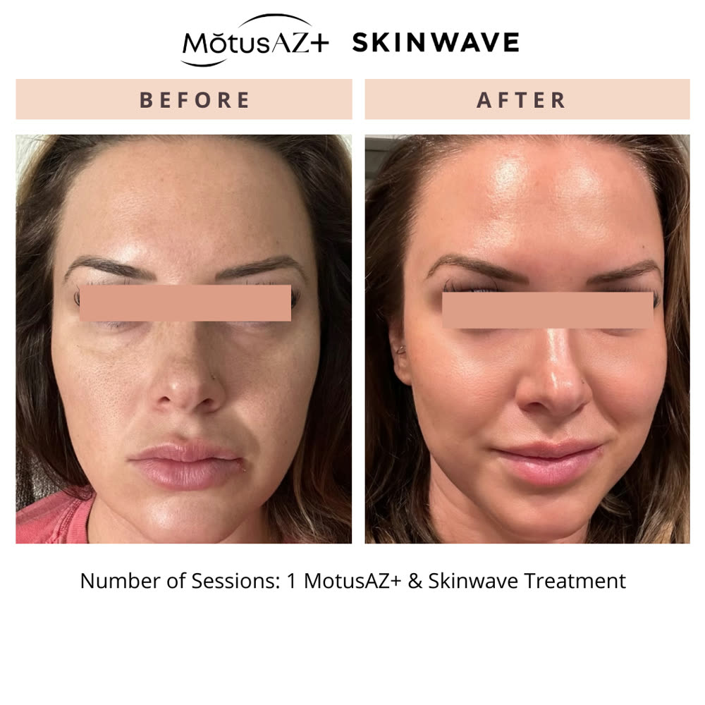 SkinWave before and after