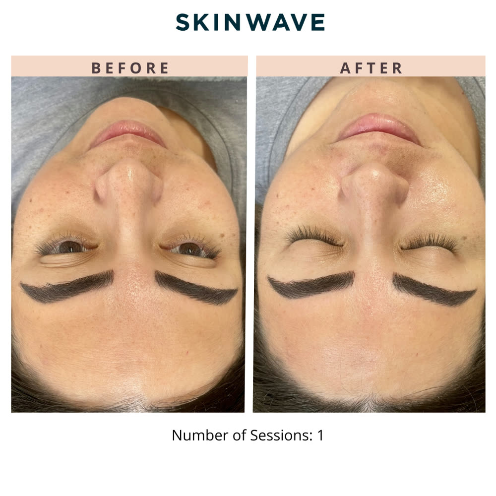 SkinWave before and after