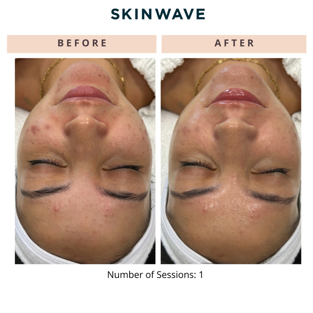SkinWave before and after