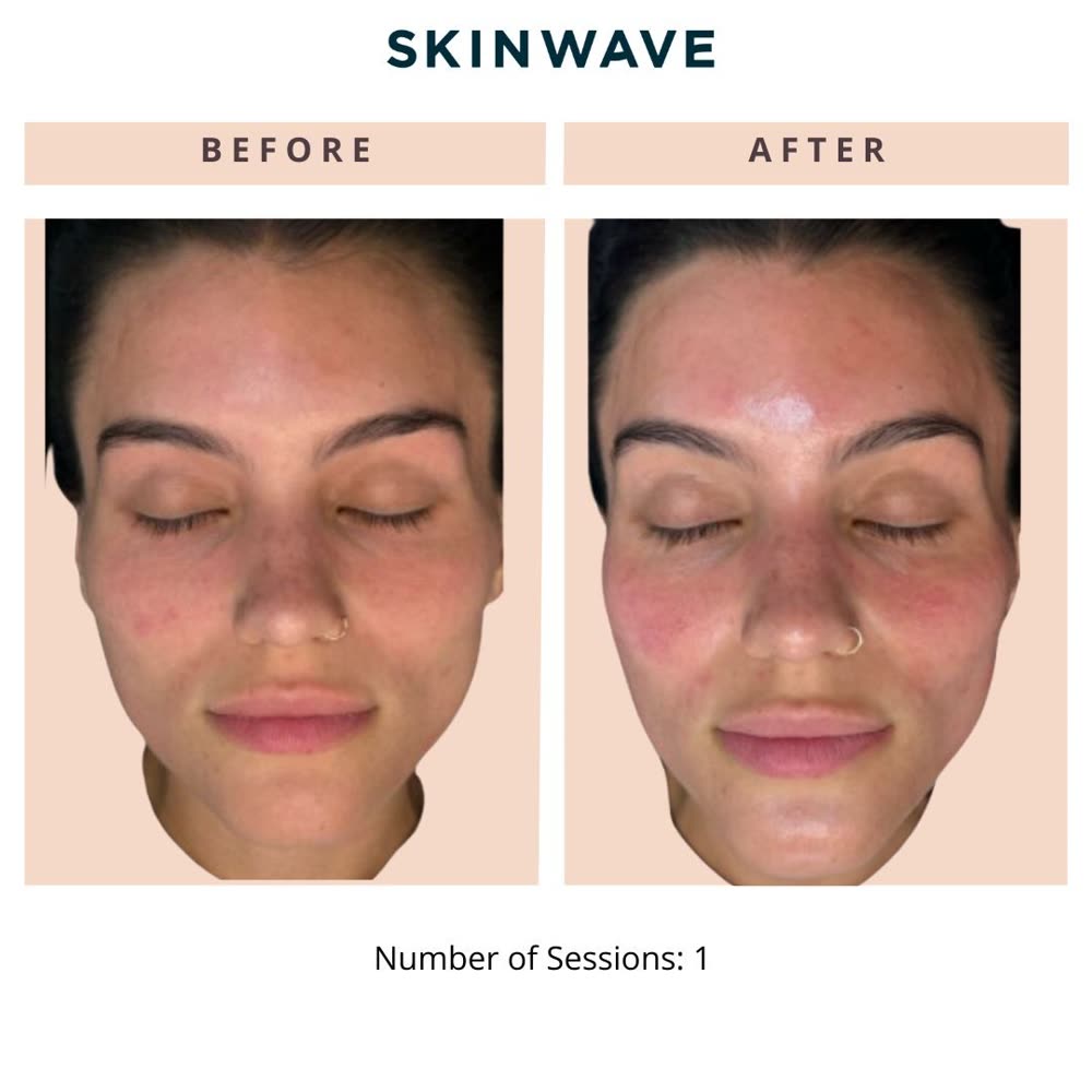 SkinWave before and after