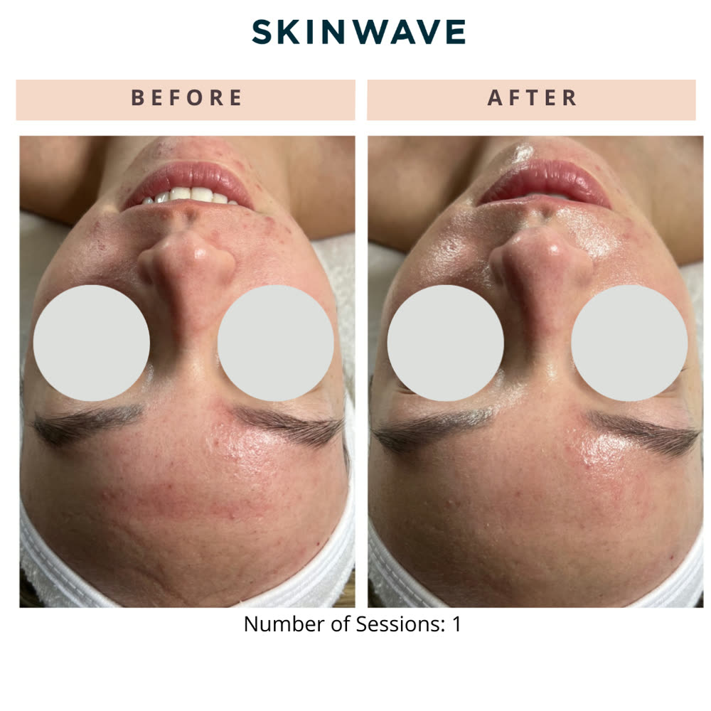 SkinWave before and after