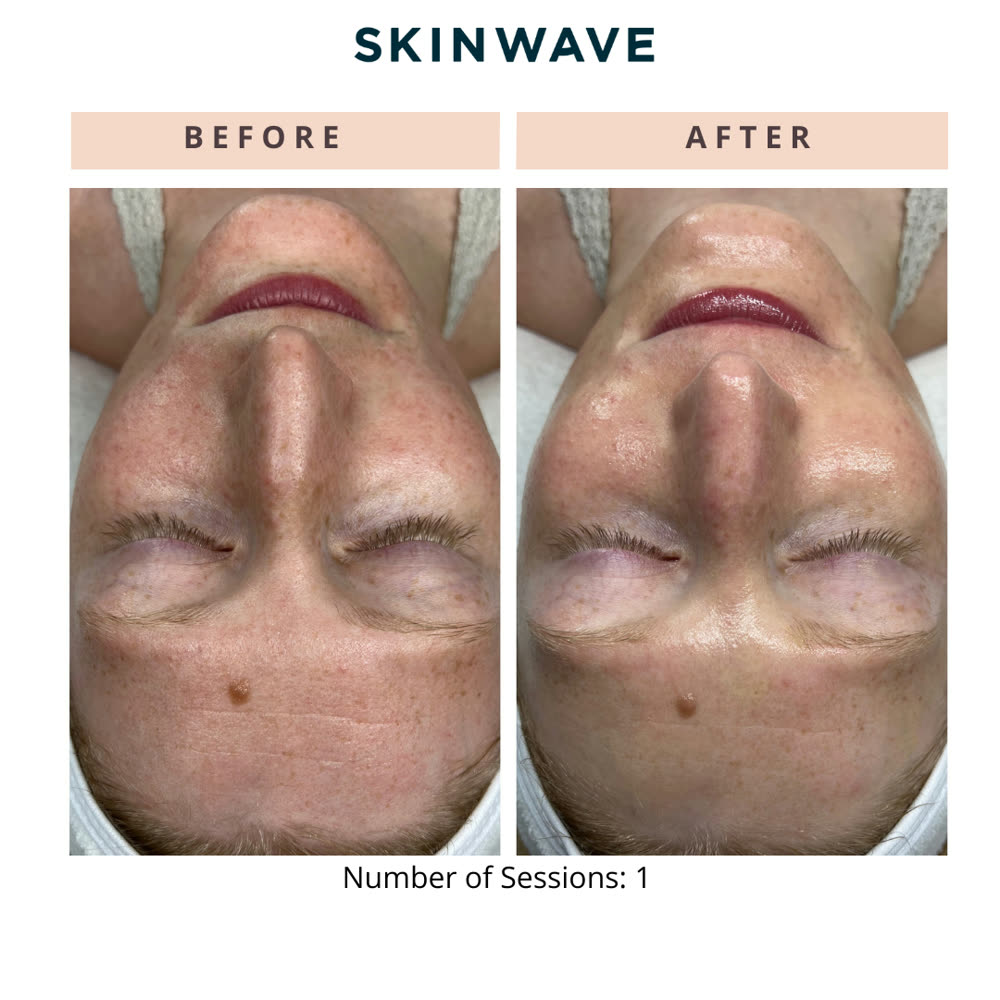 SkinWave before and after