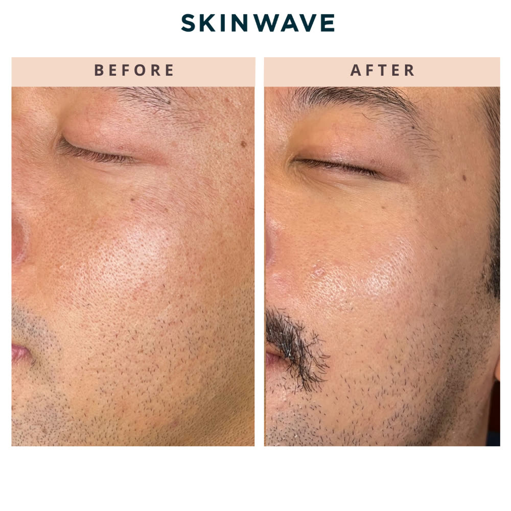 SkinWave before and after