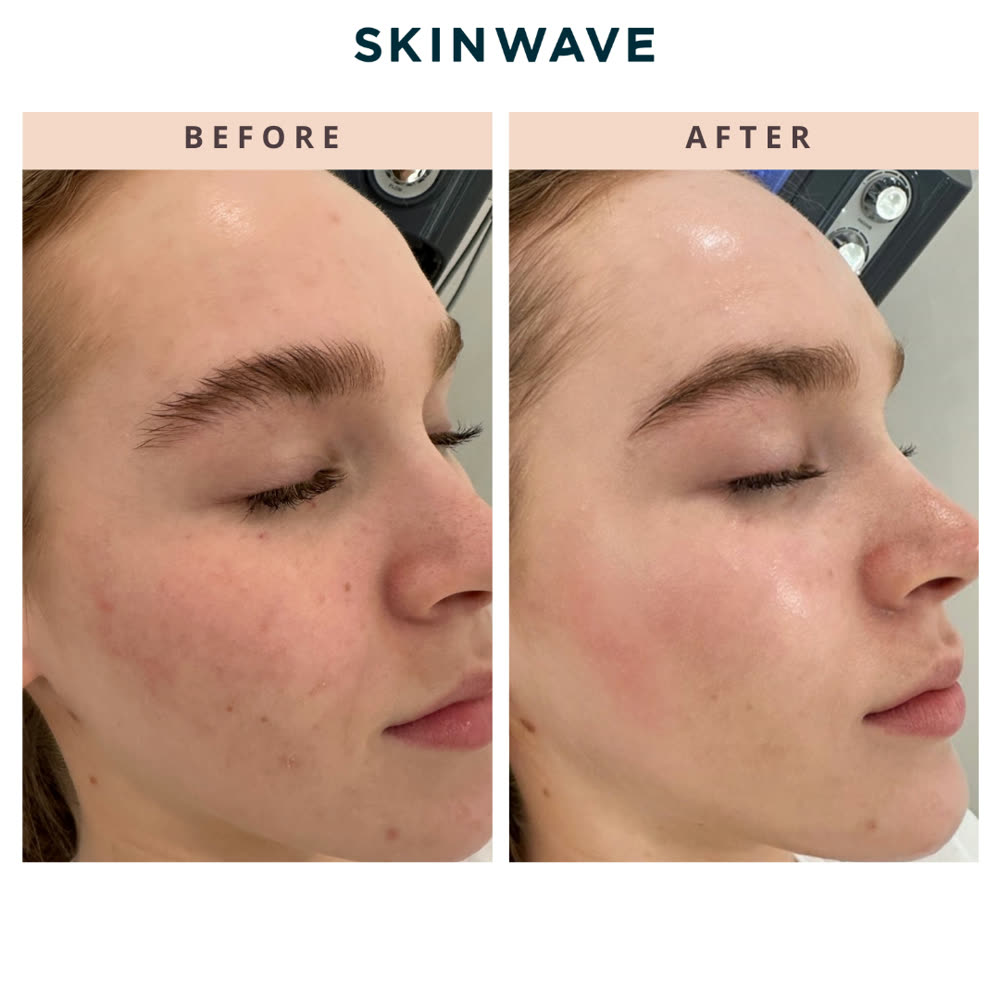 SkinWave before and after
