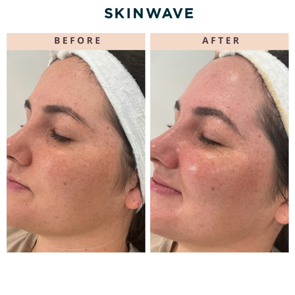 SkinWave before and after