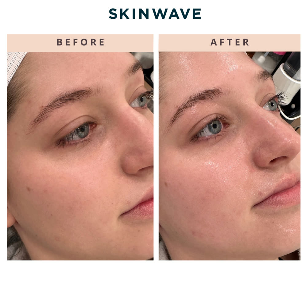 SkinWave before and after