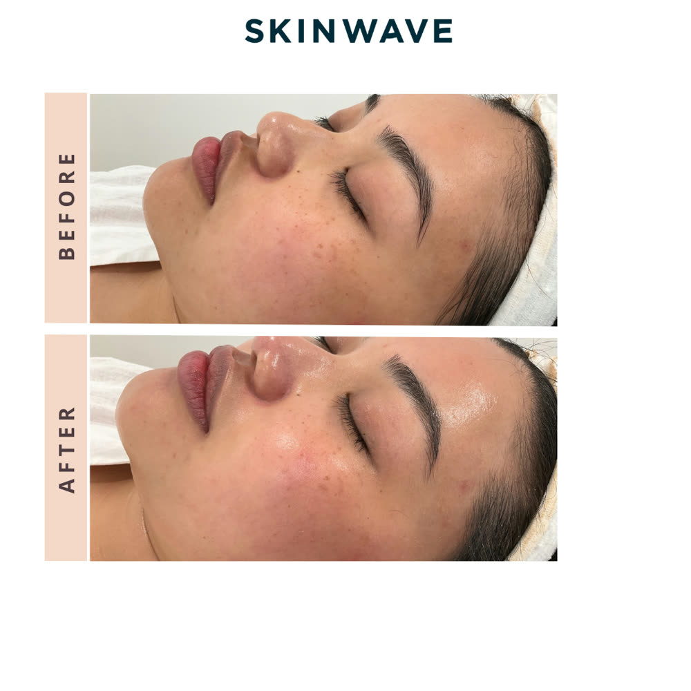 SkinWave before and after
