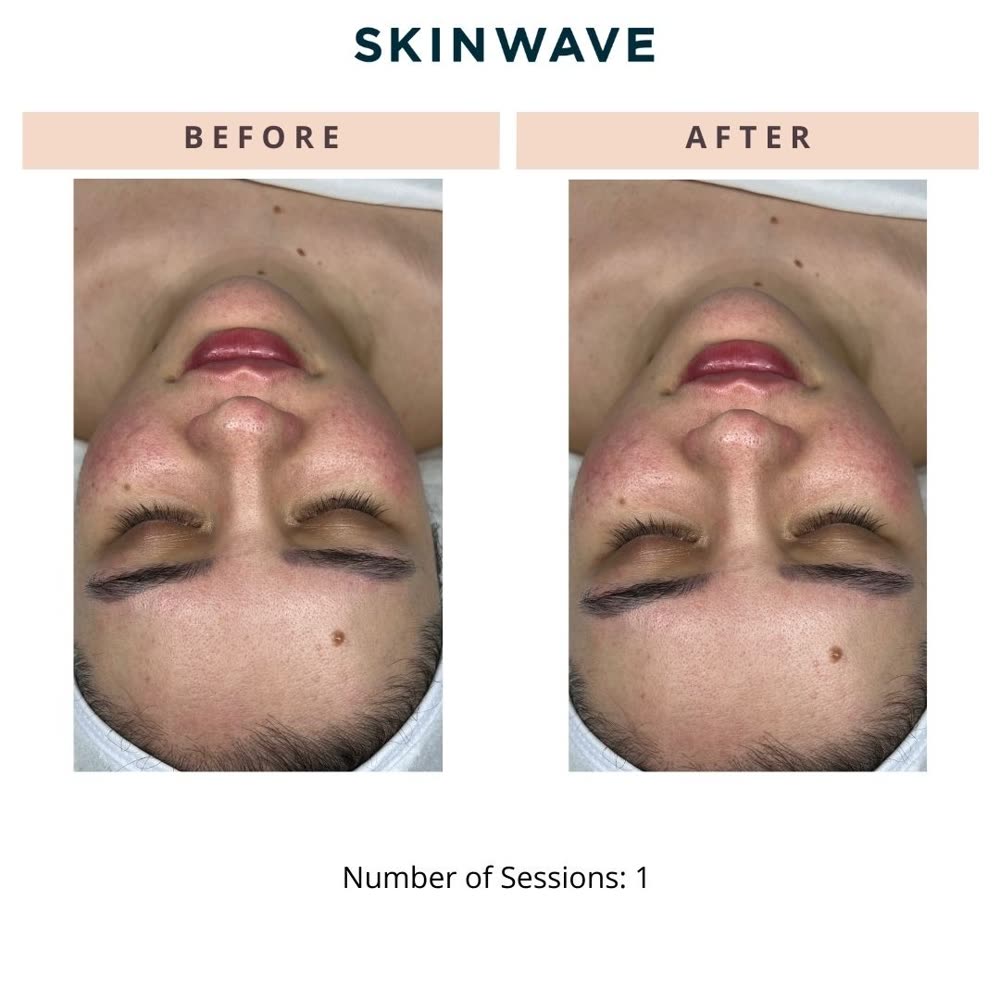 SkinWave before and after
