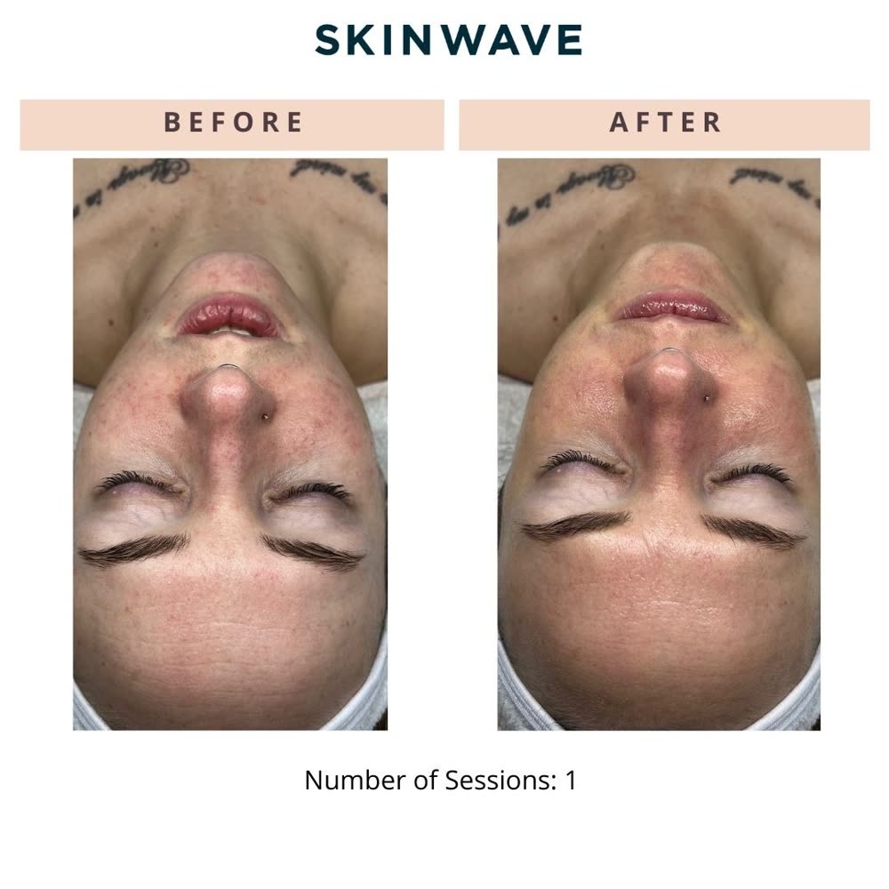 SkinWave before and after
