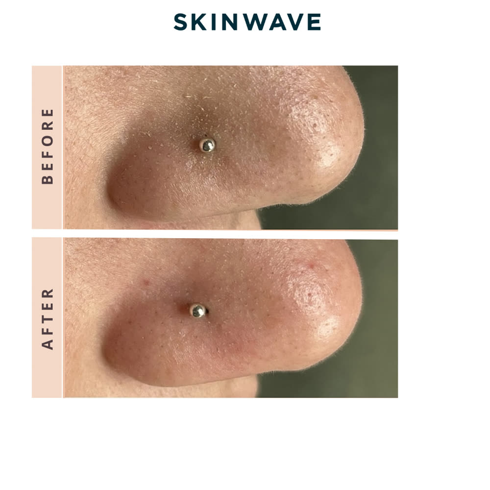 SkinWave before and after