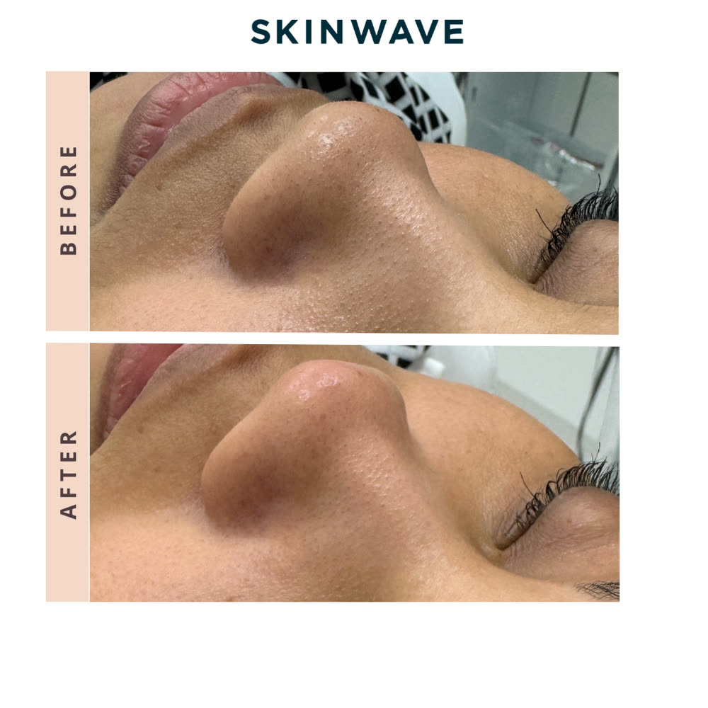 SkinWave before and after