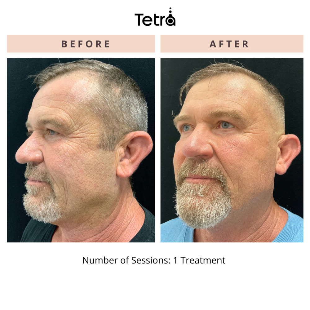 Tetra CO2 before and after