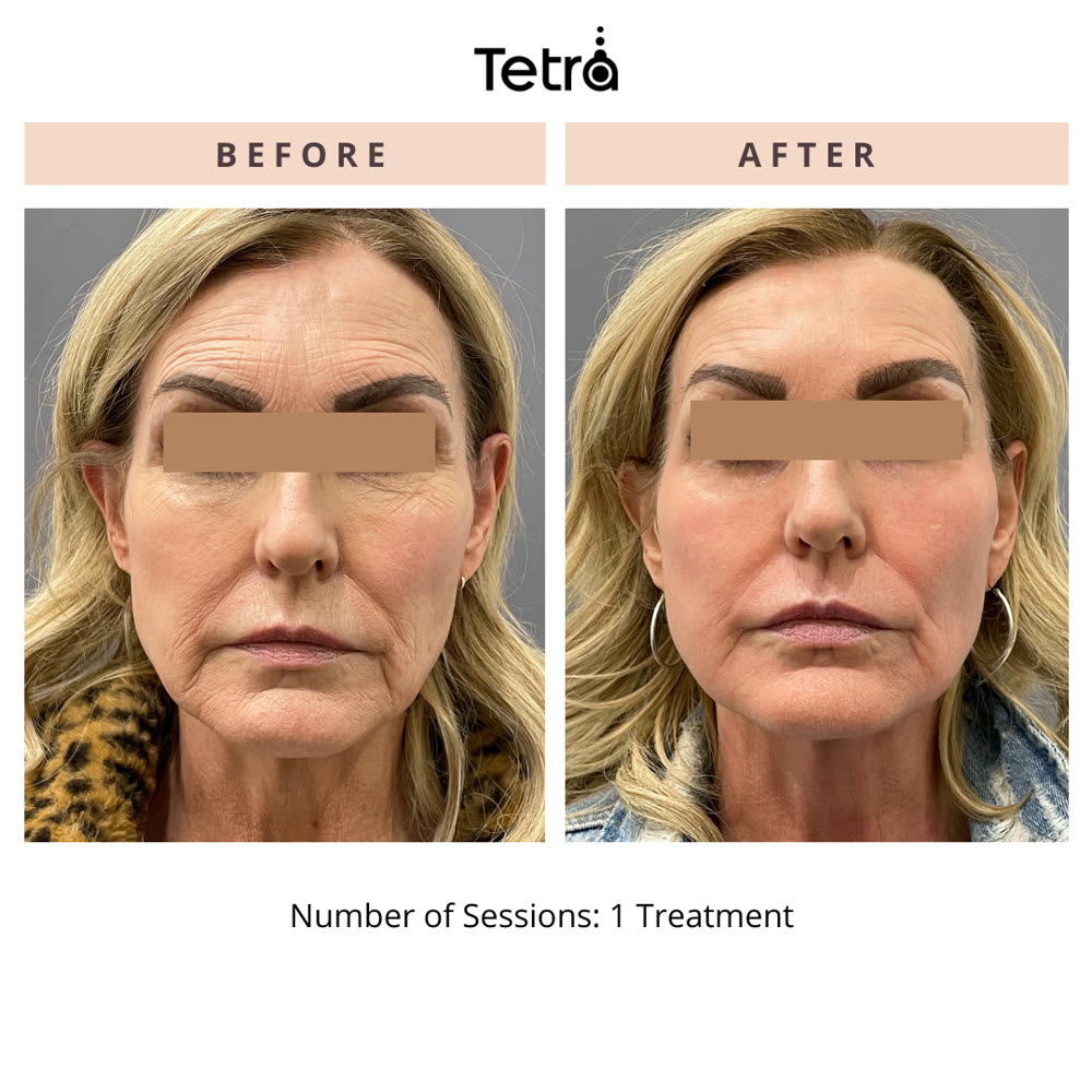 Tetra CO2 before and after