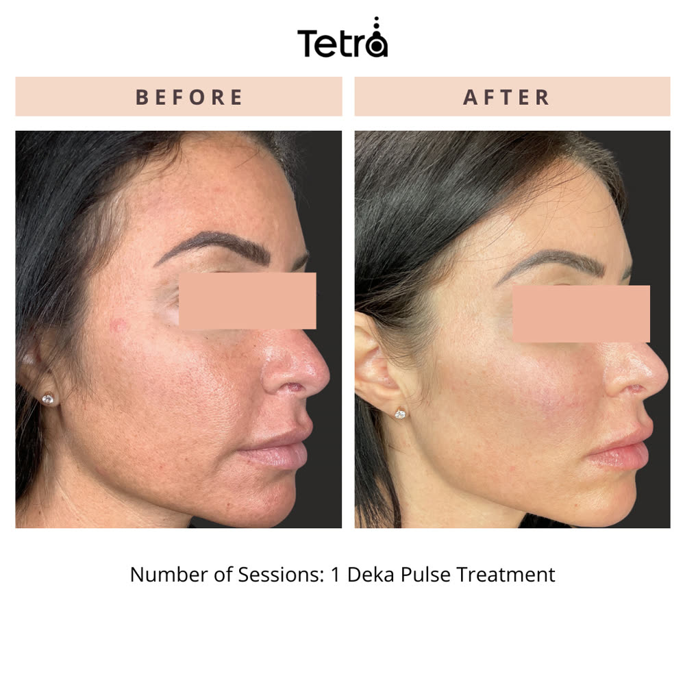 Tetra CO2 before and after