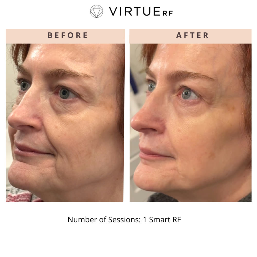 VirtueRF before and after