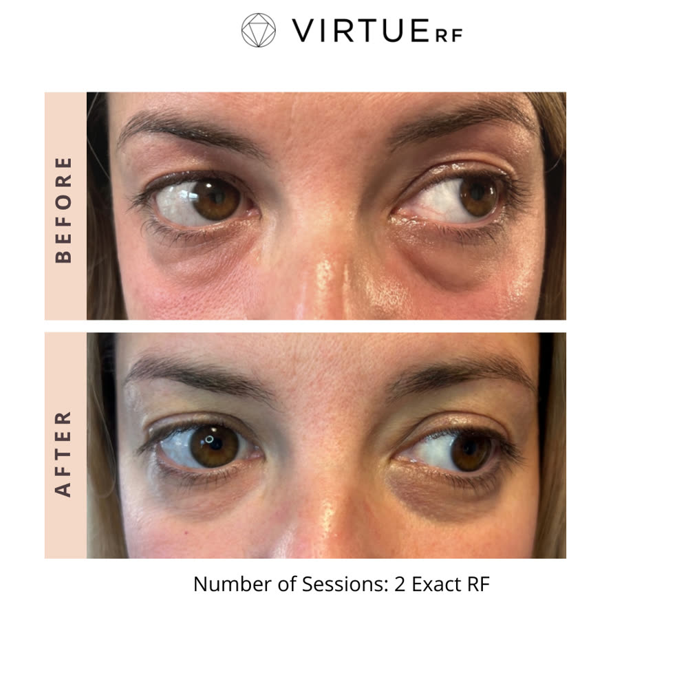 VirtueRF before and after