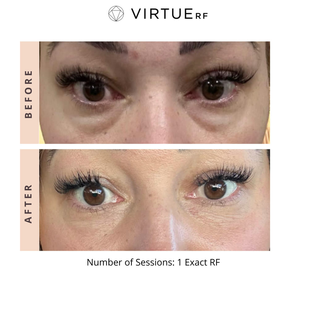 VirtueRF before and after
