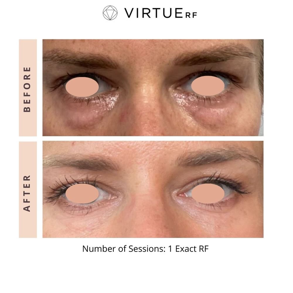 VirtueRF before and after