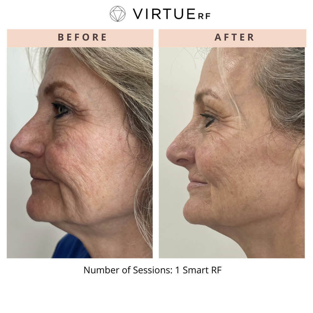 VirtueRF before and after