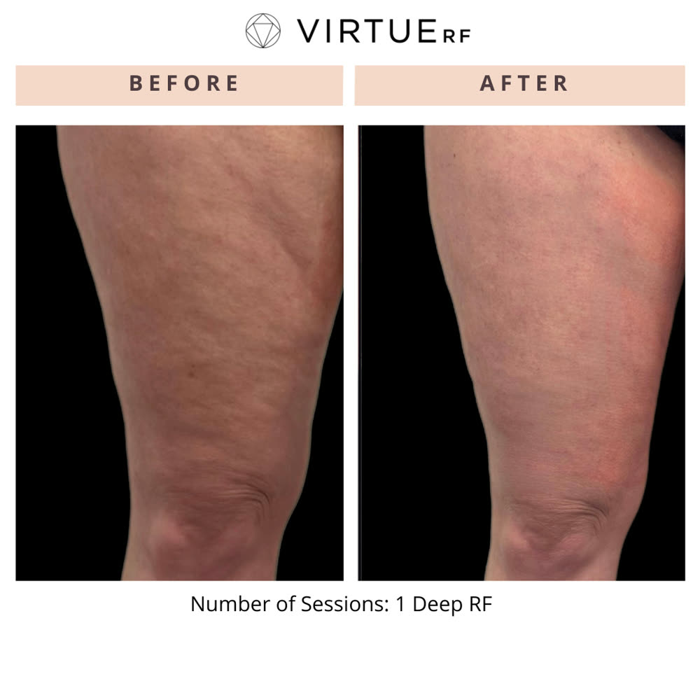 VirtueRF before and after